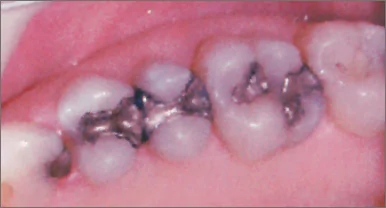 Amalgam-Fillings